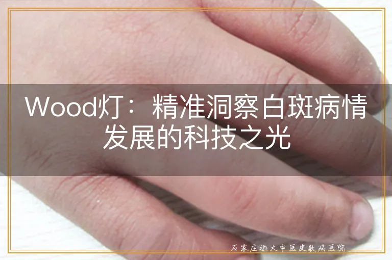 Wood灯：精准洞察白斑病情发展的科技之光