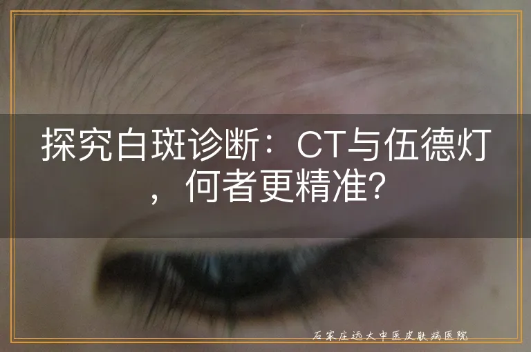 探究白斑诊断：CT与伍德灯，何者更精准？