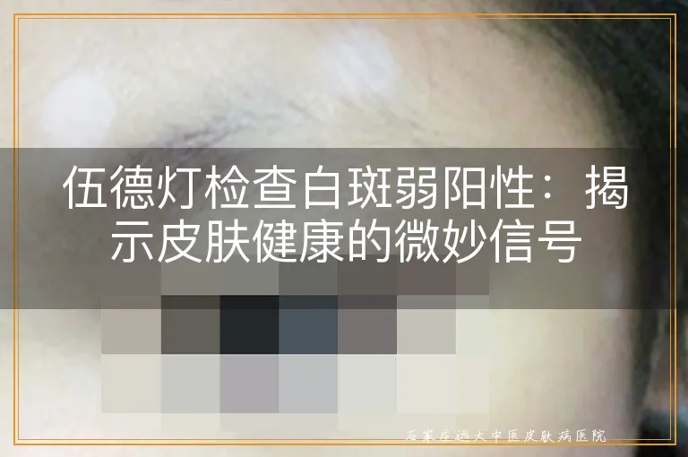 伍德灯检查白斑弱阳性：揭示皮肤健康的微妙信号