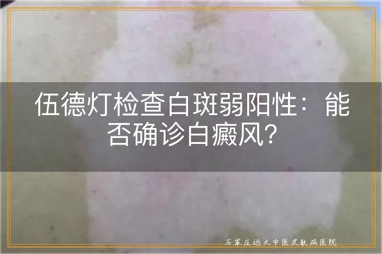 伍德灯检查白斑弱阳性：能否确诊白癜风？