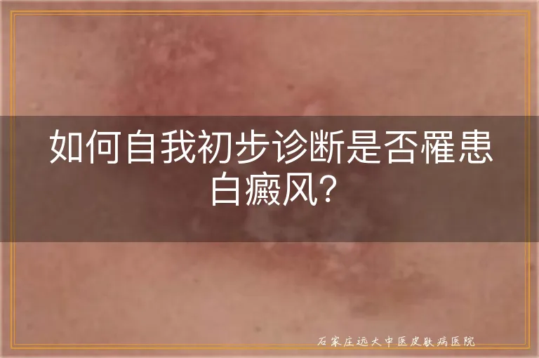 如何自我初步诊断是否罹患白癜风？