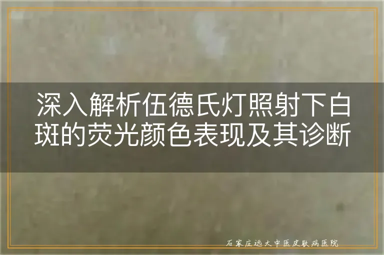 深入解析伍德氏灯照射下白斑的荧光颜色表现及其诊断意义