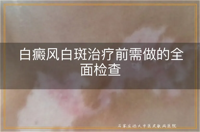 白癜风白斑治疗前需做的全面检查