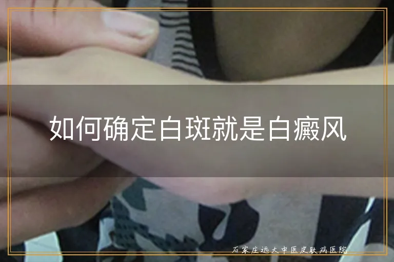 如何确定白斑就是白癜风