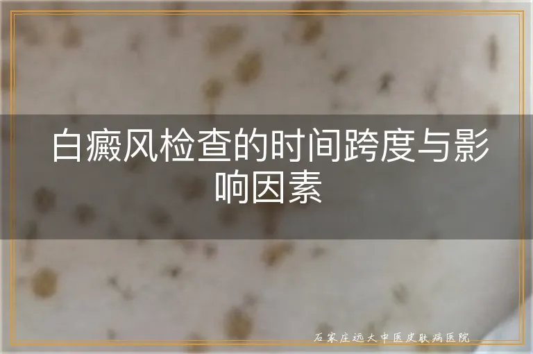 白癜风检查的时间跨度与影响因素