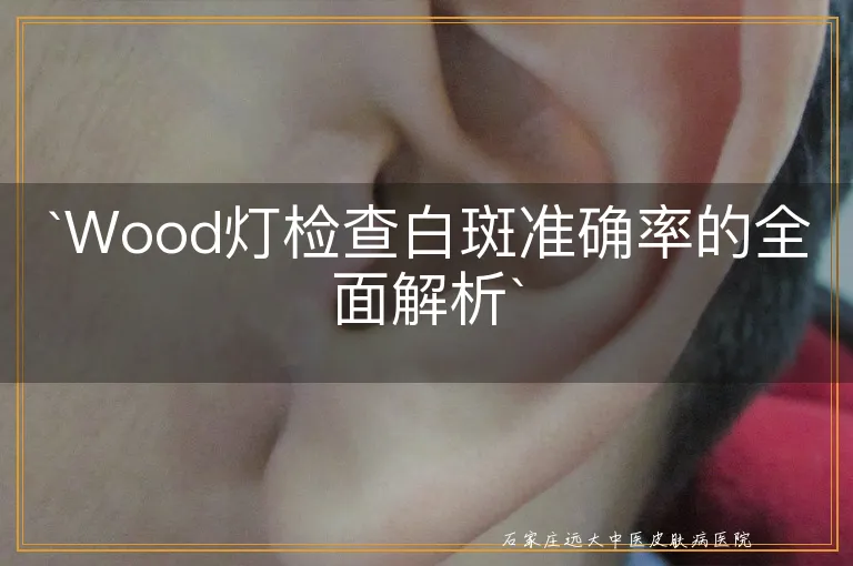 Wood灯检查白斑准确率的全面解析