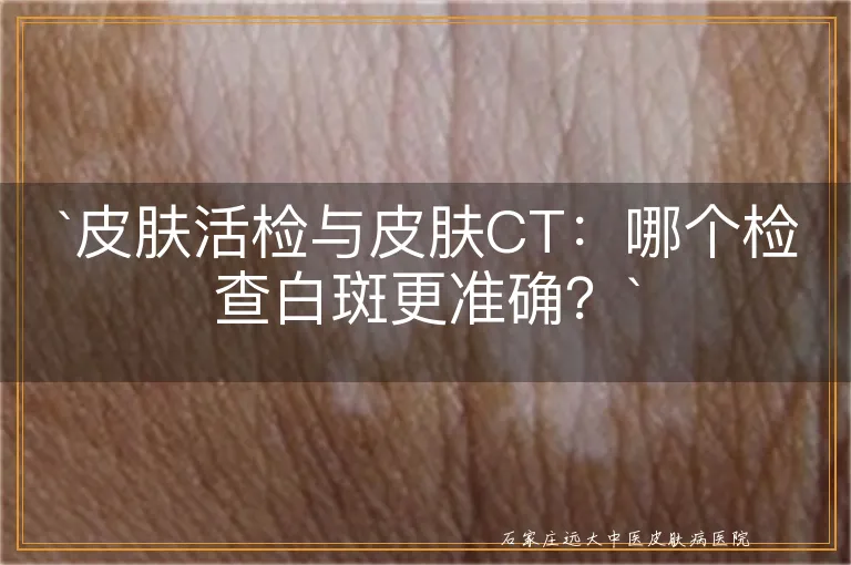 皮肤活检与皮肤CT：哪个检查白斑更准确？