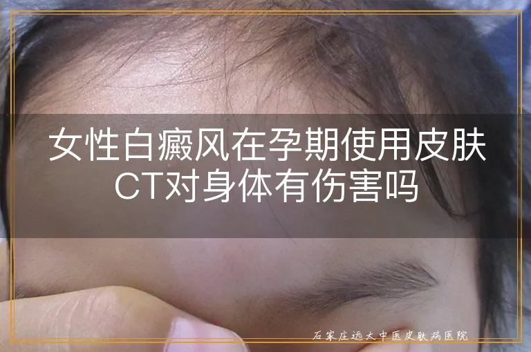 女性白癜风在孕期使用皮肤CT对身体有伤害吗