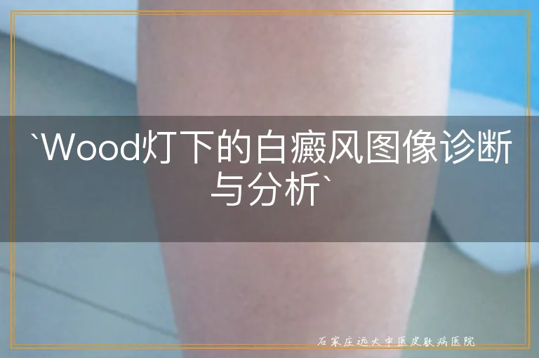 Wood灯下的白癜风图像诊断与分析