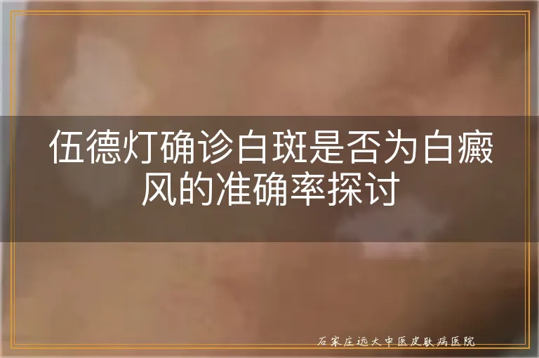 伍德灯确诊白斑是否为白癜风的准确率探讨