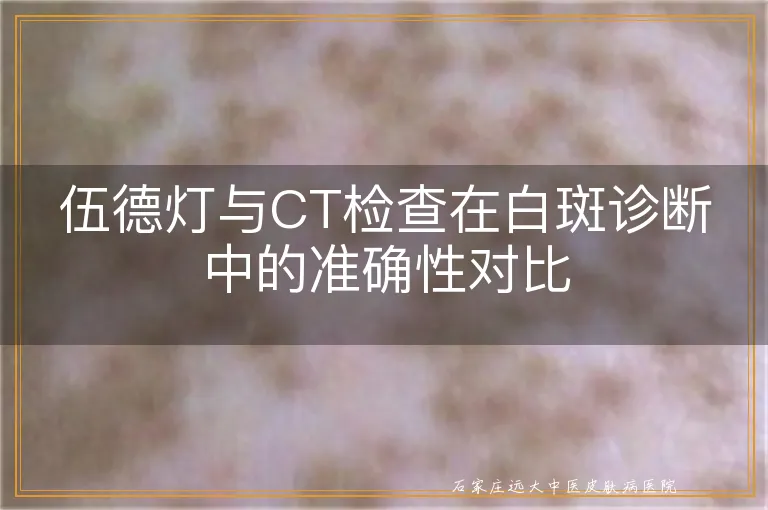 伍德灯与CT检查在白斑诊断中的准确性对比