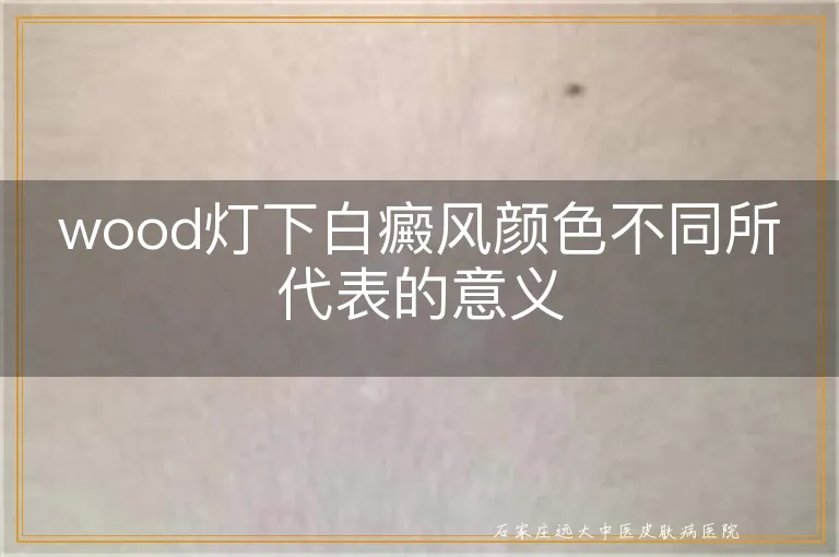 wood灯下白癜风颜色不同所代表的意义