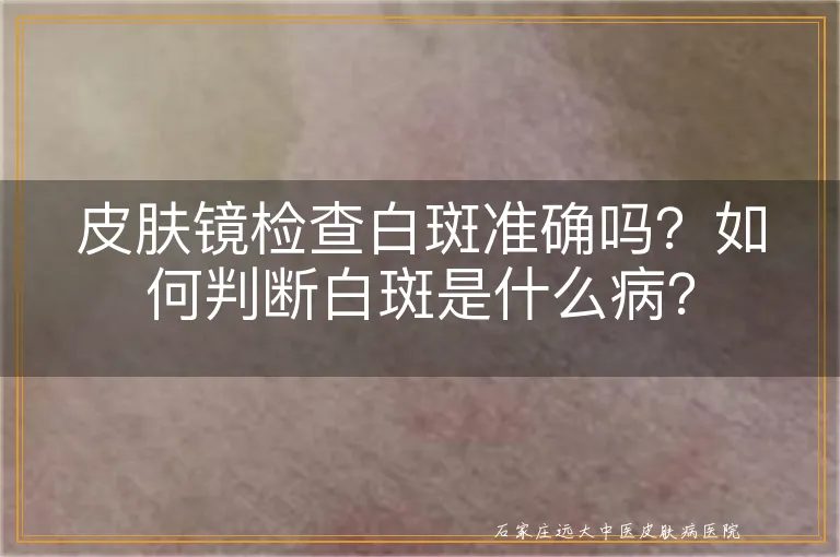 皮肤镜检查白斑准确吗？如何判断白斑是什么病？