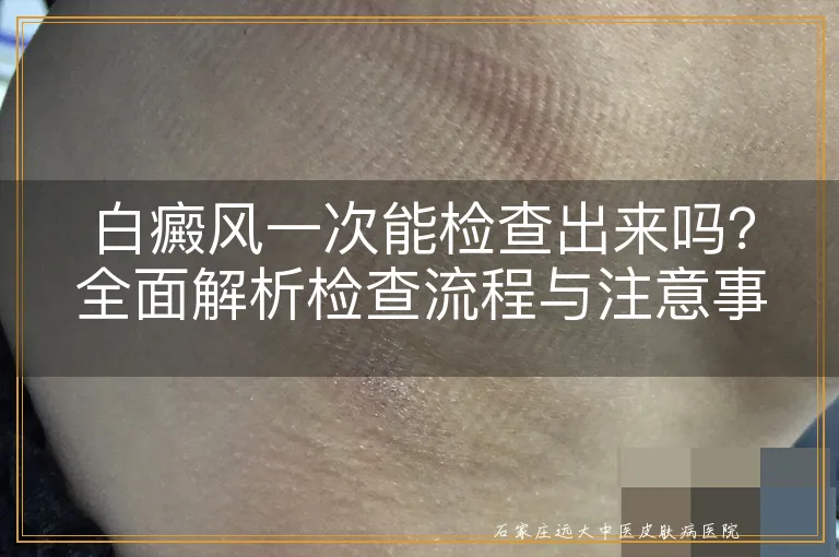 白癜风一次能检查出来吗？全面解析检查流程与注意事项