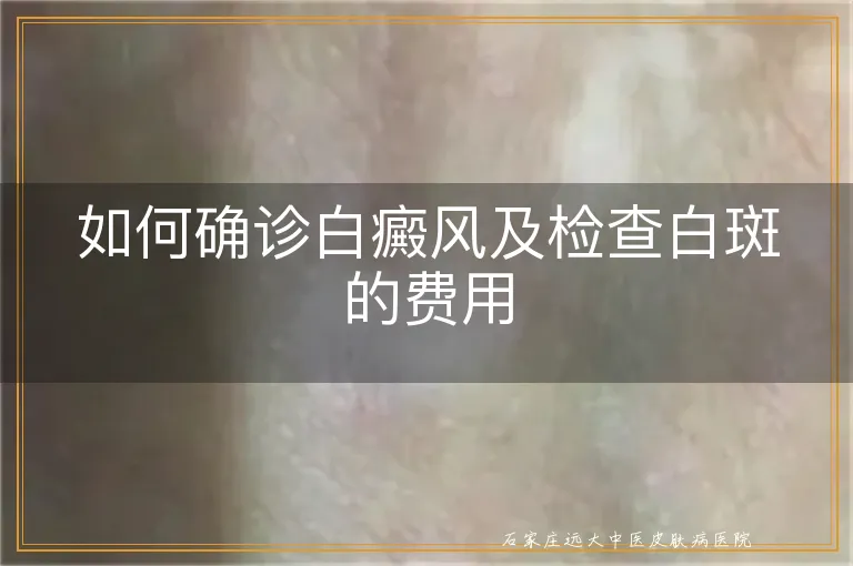 如何确诊白癜风及检查白斑的费用