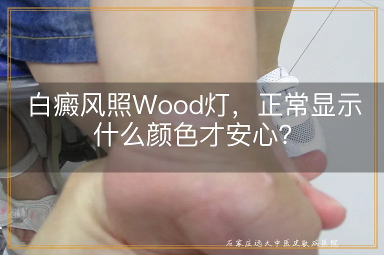 白癜风照Wood灯，正常显示什么颜色才安心？