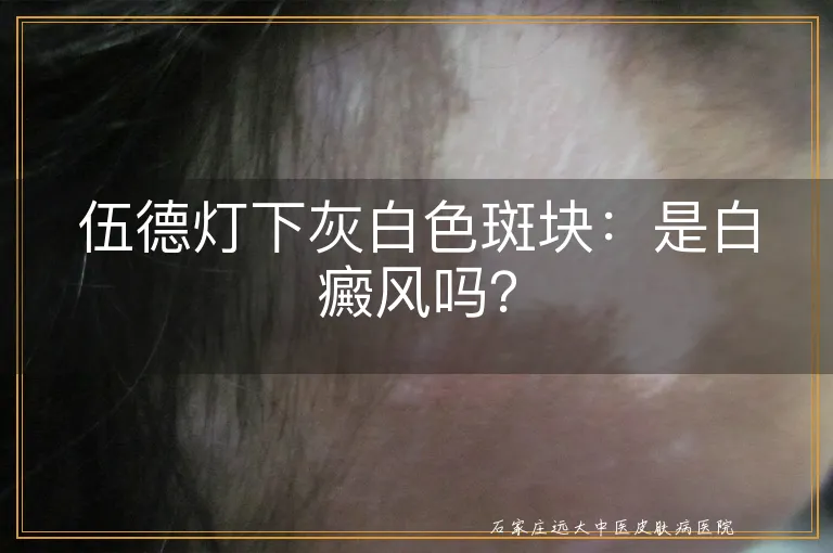 伍德灯下灰白色斑块：是白癜风吗？