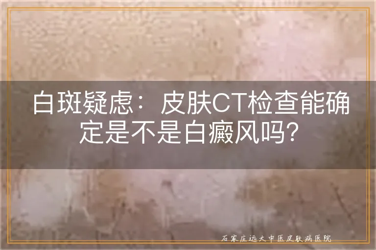 白斑疑虑：皮肤CT检查能确定是不是白癜风吗？