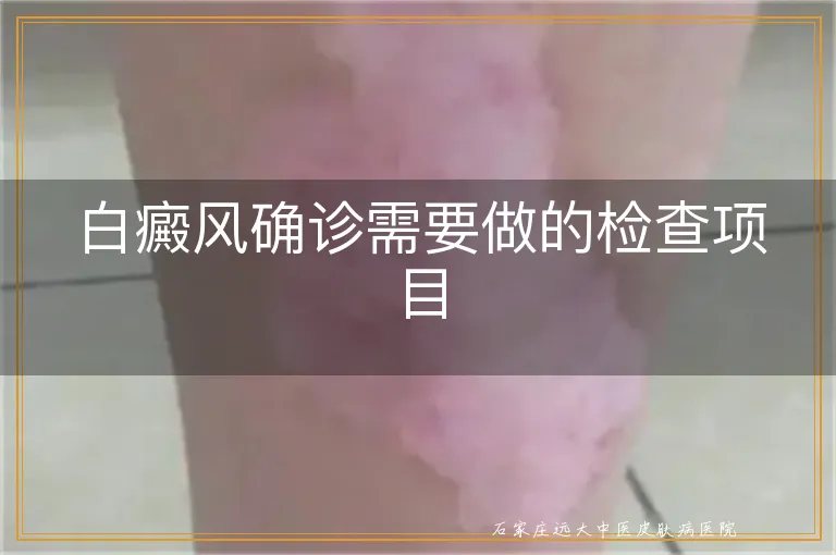 白癜风确诊需要做的检查项目