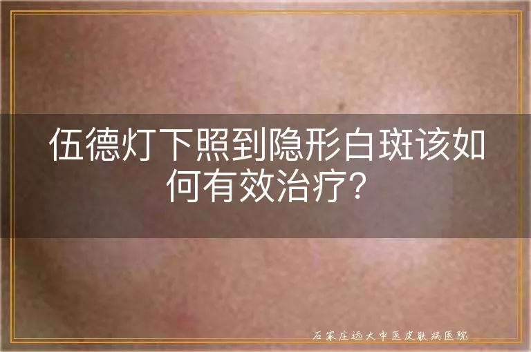 伍德灯下照到隐形白斑该如何有效治疗？