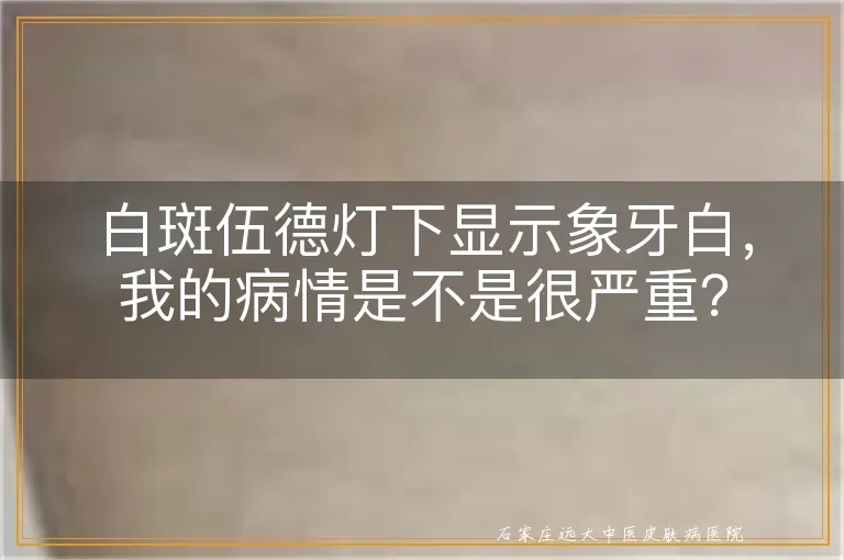 白斑伍德灯下显示象牙白，我的病情是不是很严重？