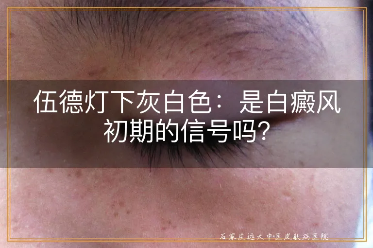 伍德灯下灰白色：是白癜风初期的信号吗？