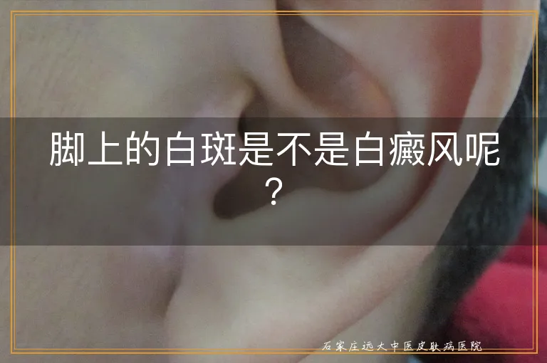 脚上的白斑是不是白癜风呢？