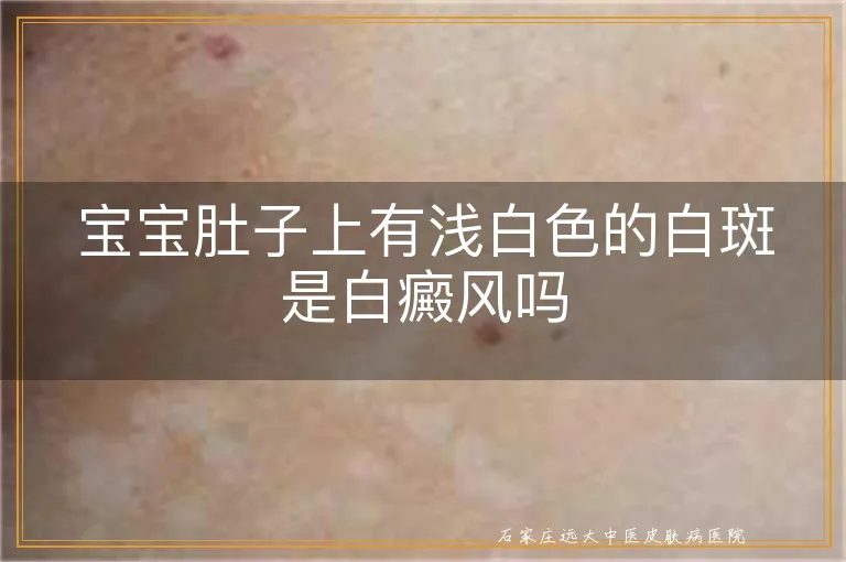 宝宝肚子上有浅白色的白斑是白癜风吗