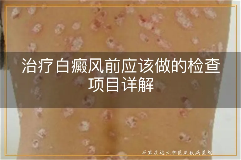 治疗白癜风前应该做的检查项目详解