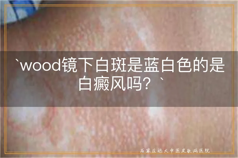 wood镜下白斑是蓝白色的是白癜风吗？