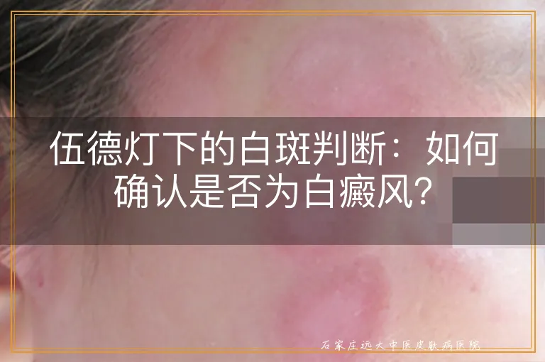 伍德灯下的白斑判断：如何确认是否为白癜风？