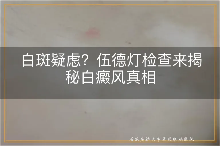 白斑疑虑？伍德灯检查来揭秘白癜风真相