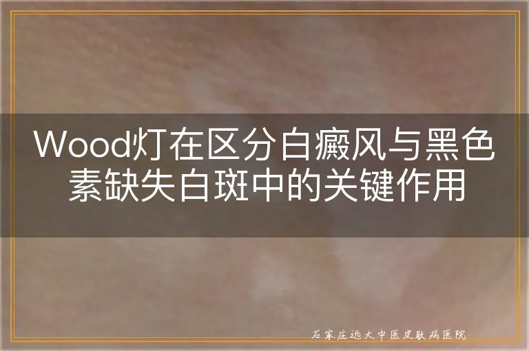 Wood灯在区分白癜风与黑色素缺失白斑中的关键作用