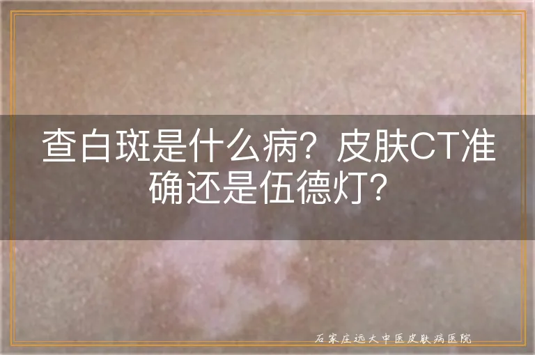 查白斑是什么病？皮肤CT准确还是伍德灯？