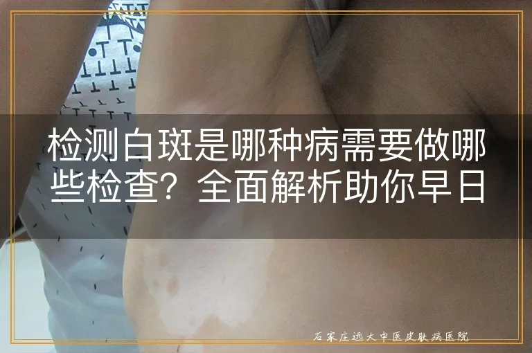 检测白斑是哪种病需要做哪些检查？全面解析助你早日明确病因