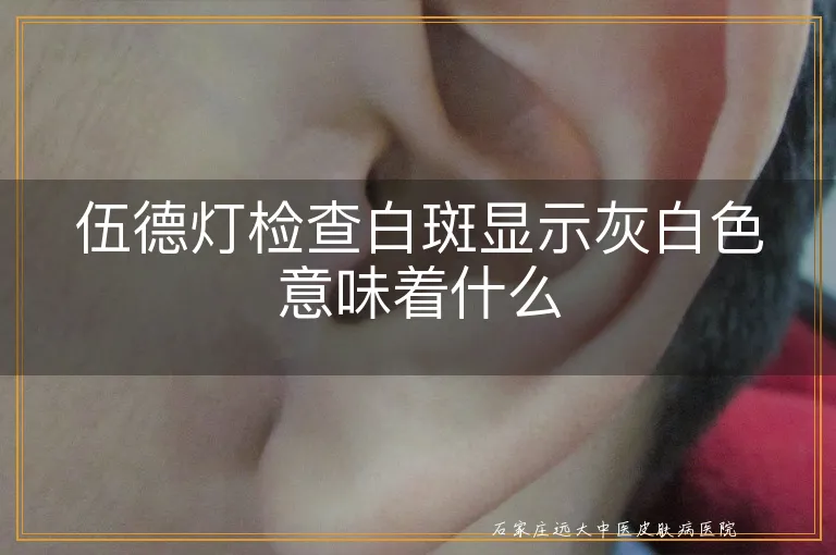 伍德灯检查白斑显示灰白色意味着什么