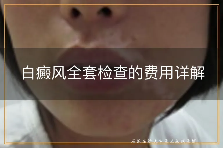 白癜风全套检查的费用详解