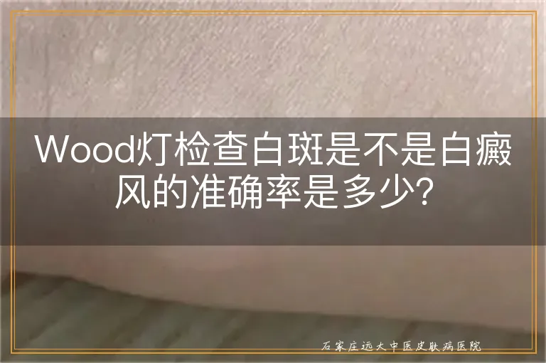 Wood灯检查白斑是不是白癜风的准确率是多少？