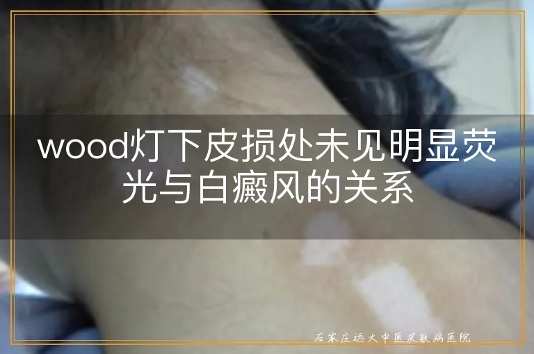 wood灯下皮损处未见明显荧光与白癜风的关系