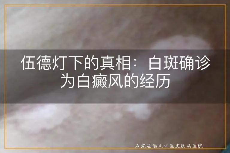 伍德灯下的真相：白斑确诊为白癜风的经历