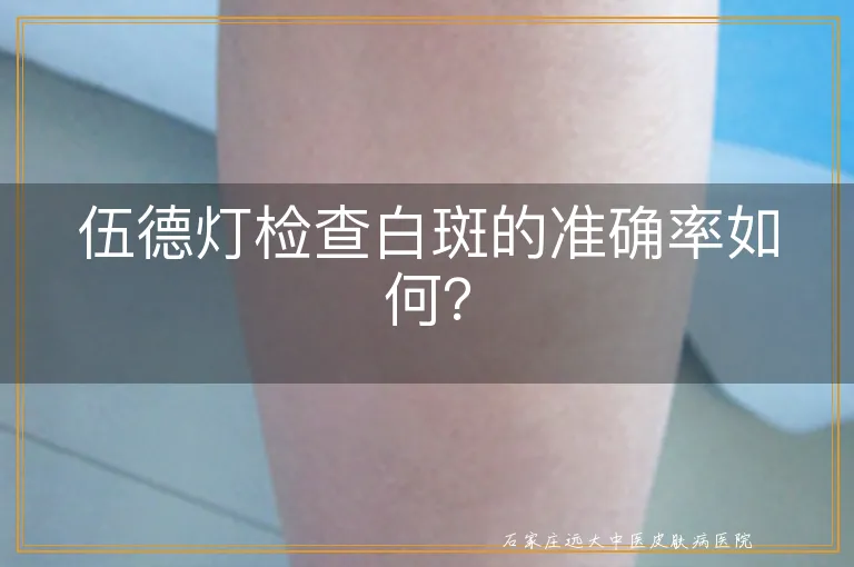 伍德灯检查白斑的准确率如何？