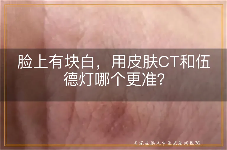 脸上有块白，用皮肤CT和伍德灯哪个更准？