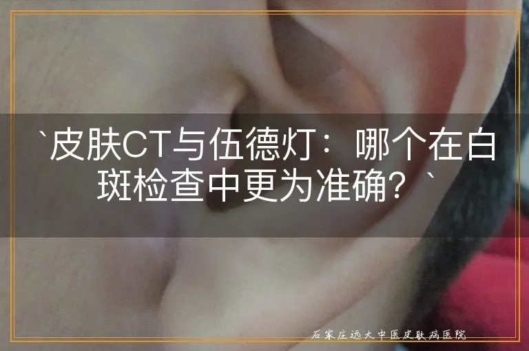 皮肤CT与伍德灯：哪个在白斑检查中更为准确？