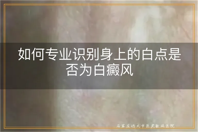 如何专业识别身上的白点是否为白癜风