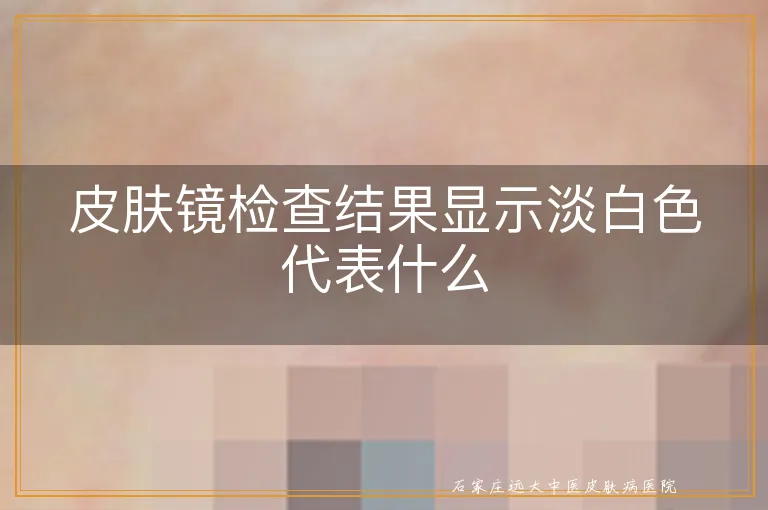 皮肤镜检查结果显示淡白色代表什么