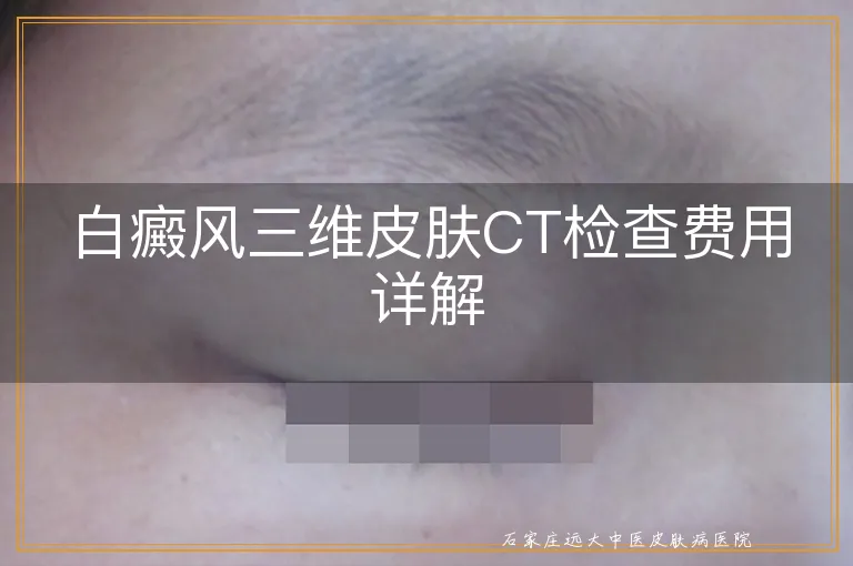 白癜风三维皮肤CT检查费用详解