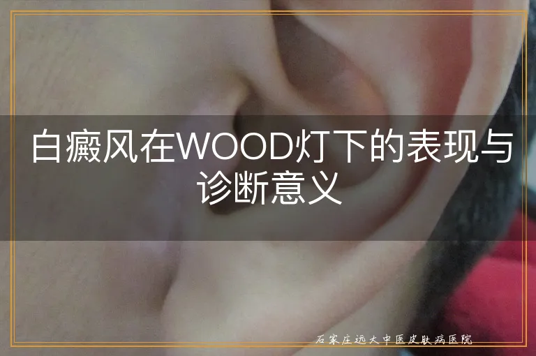 白癜风在WOOD灯下的表现与诊断意义