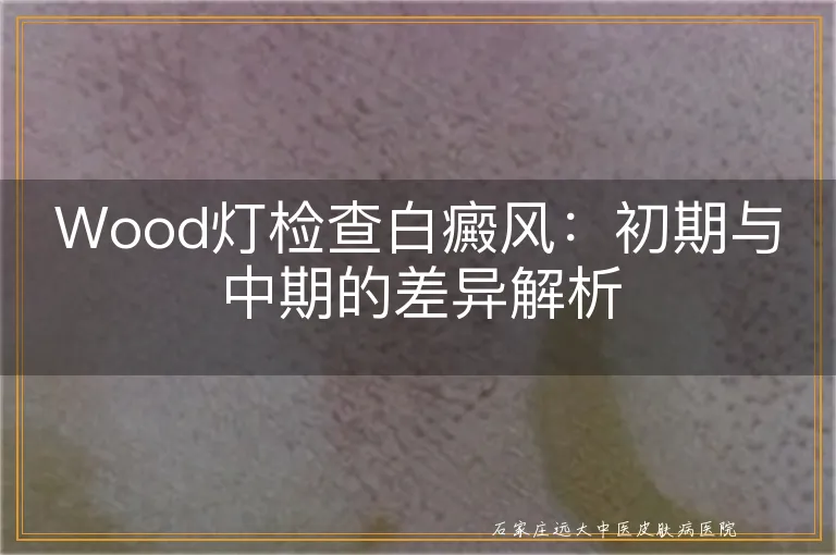 Wood灯检查白癜风：初期与中期的差异解析