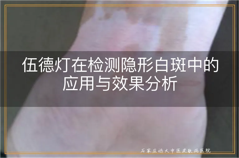 伍德灯在检测隐形白斑中的应用与效果分析