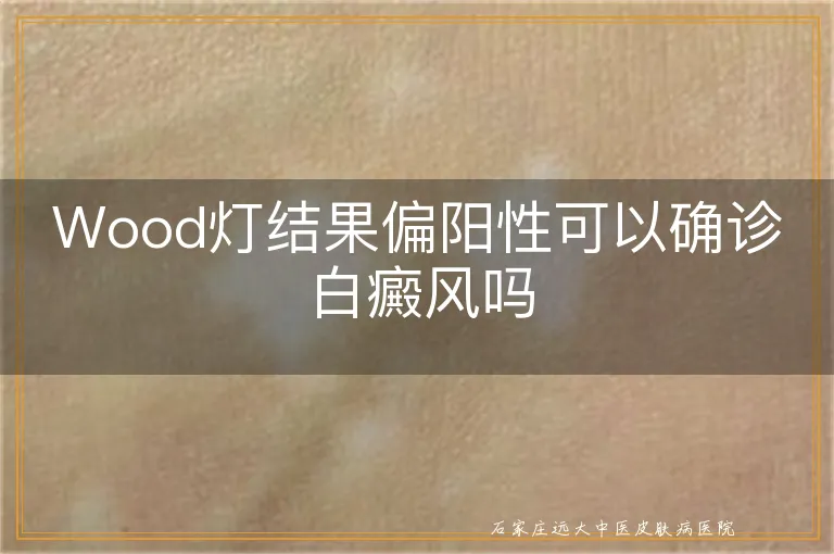 Wood灯结果偏阳性可以确诊白癜风吗